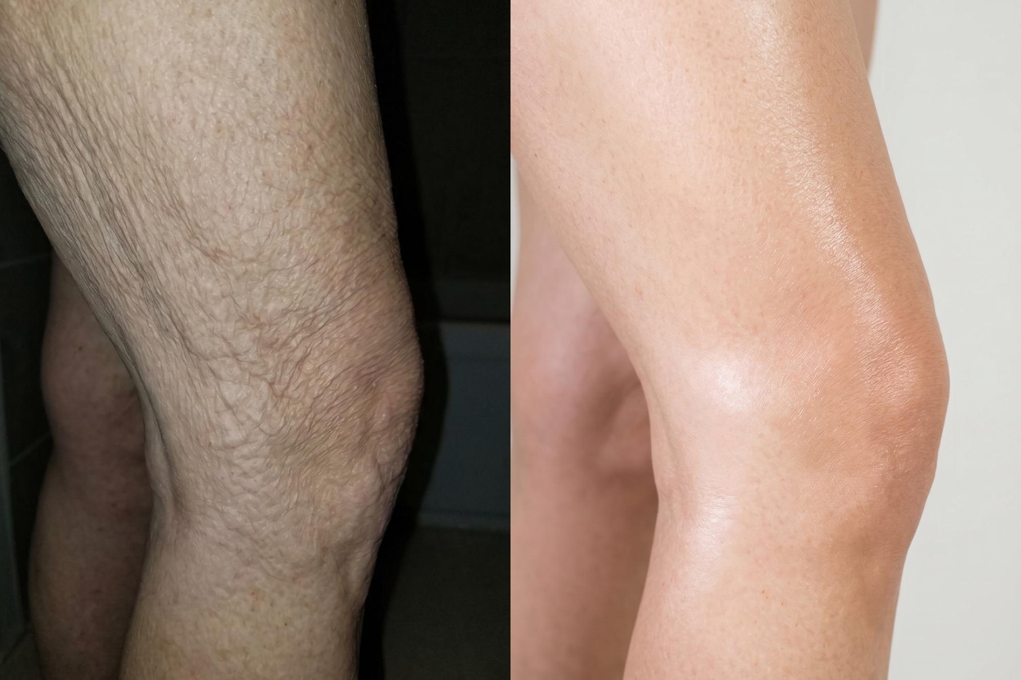 Before and after using a firming body oil on crepey skin